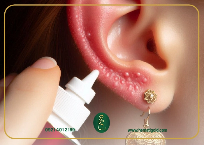 چگونه از حساسیت به طلا جلوگیری کنیم؟ روش‌های درمان و پیشگیری